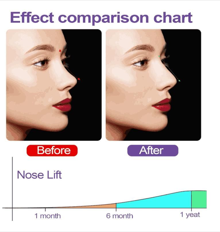 Nose Up Clip for Nose Shaping – High Lifting Silicone Clipper Tool for Nose Bridge Correction